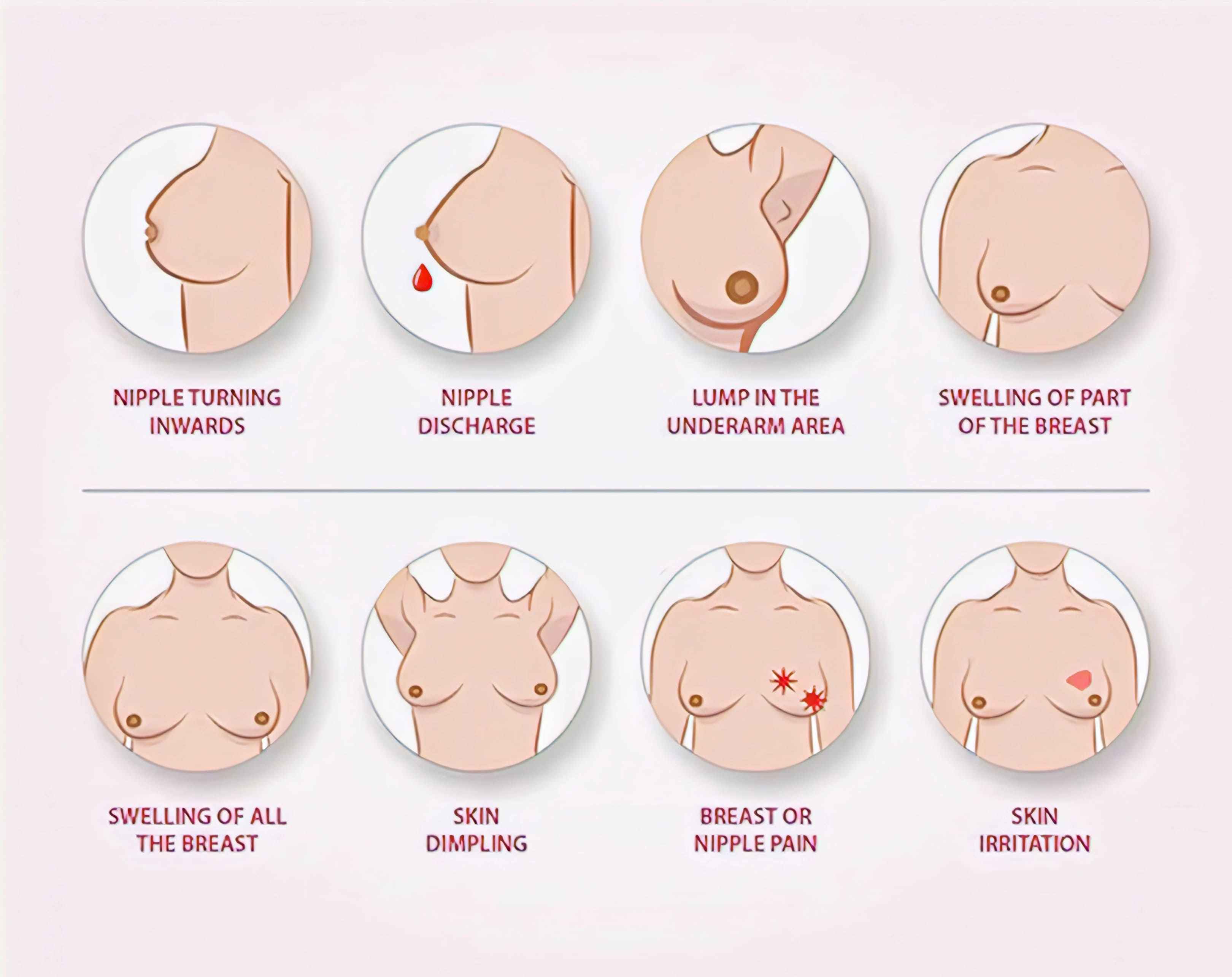 Be Breast Aware - common symptoms of suspected breast cancer